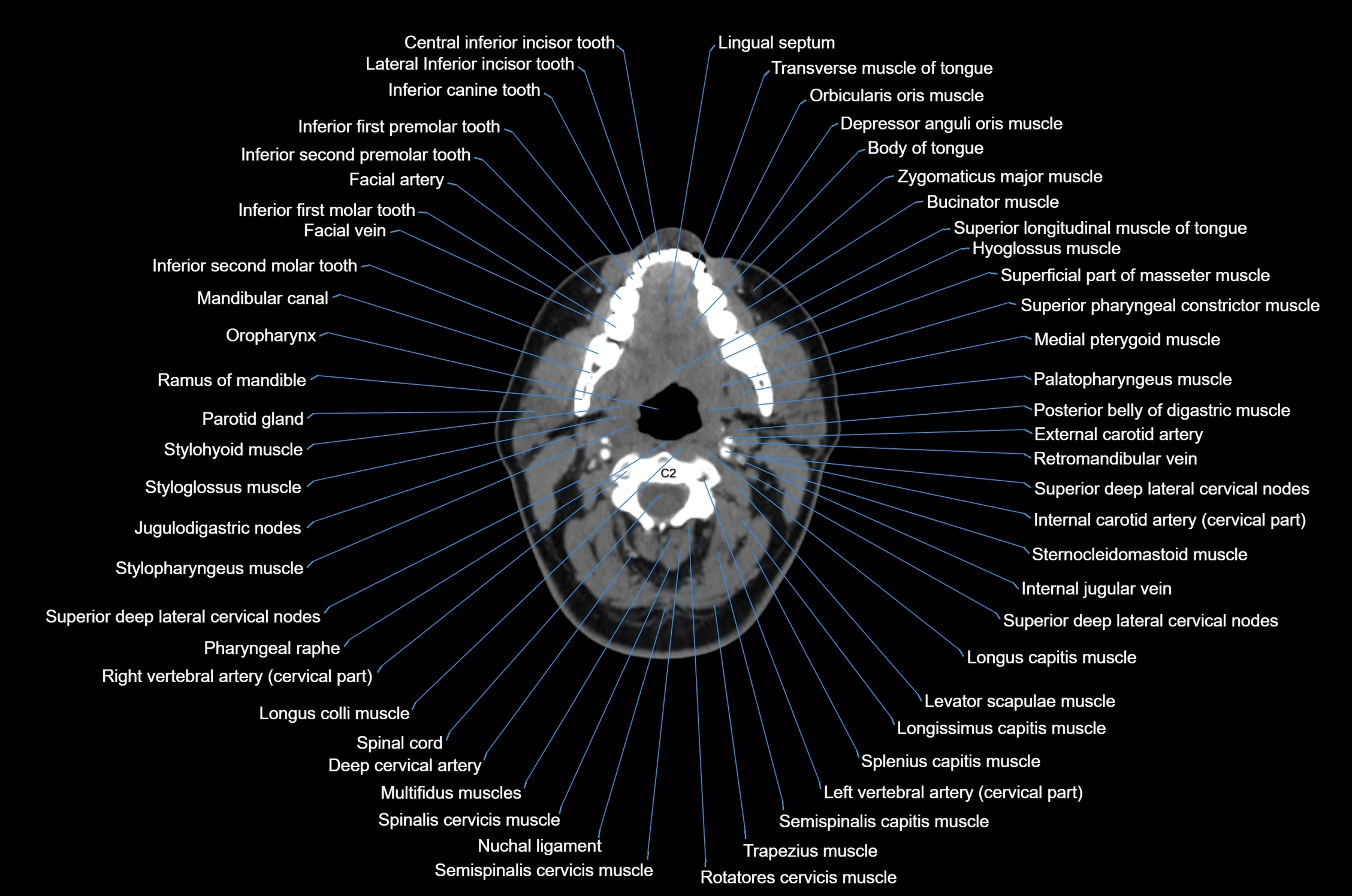 CT Neck axial cross sectional anatomy radiology image-img-00001-00029.webp